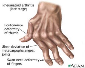 Aamvata-arthritis